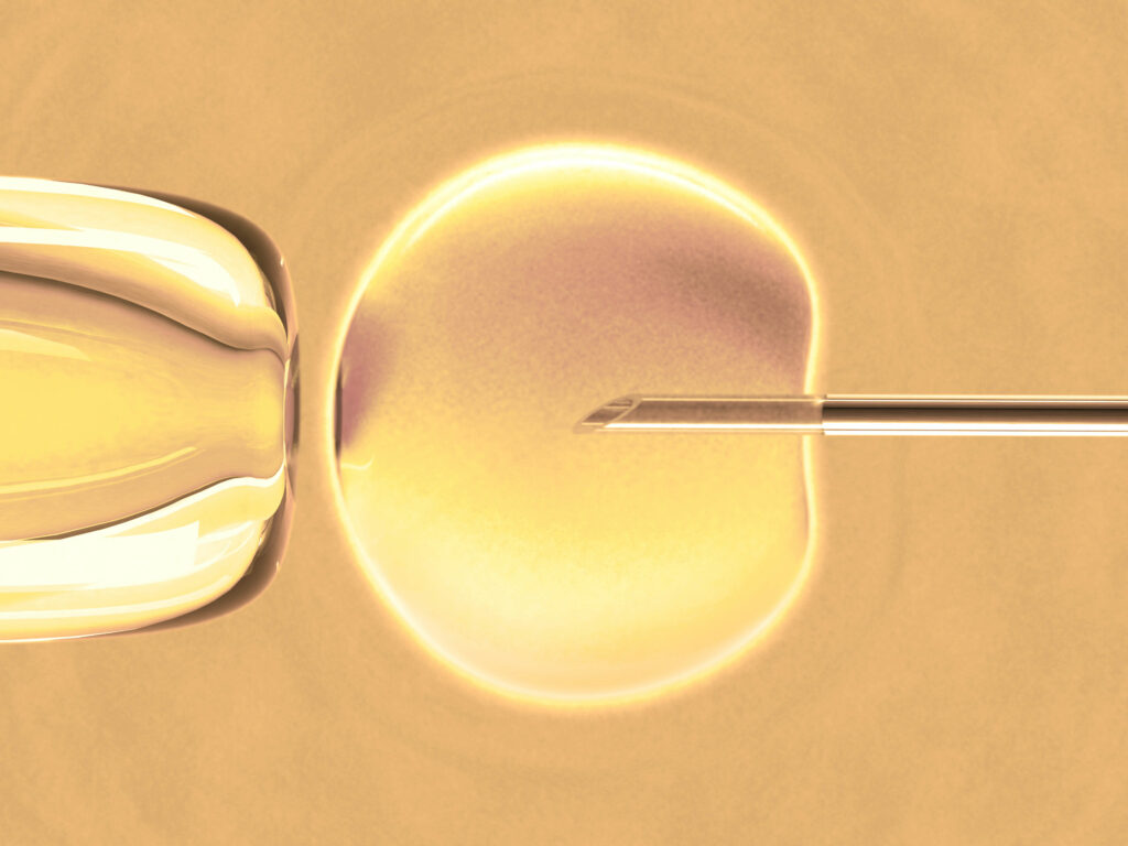 Intracytoplasmic Sperm Injection